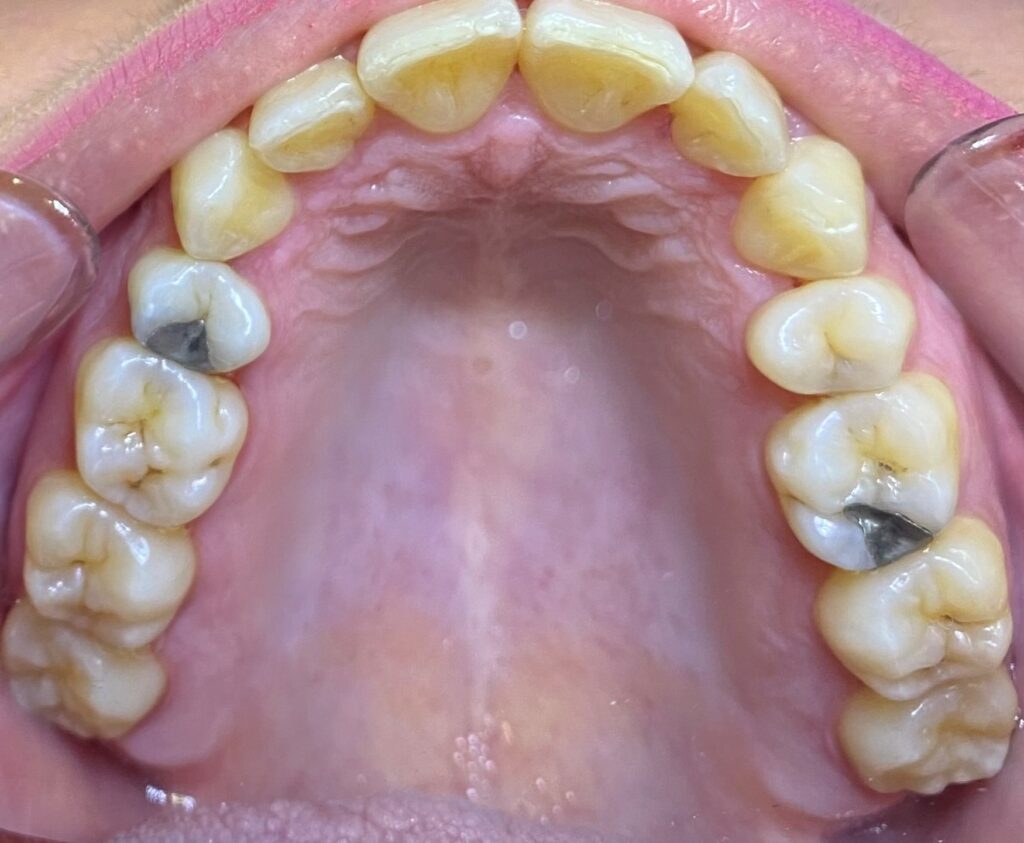 ορθοδοντική ενηλίκων