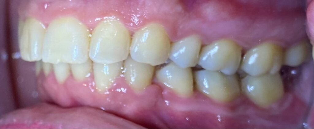 ορθοδοντική ενηλίκων