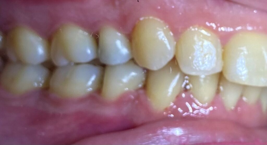 ορθοδοντική ενηλίκων