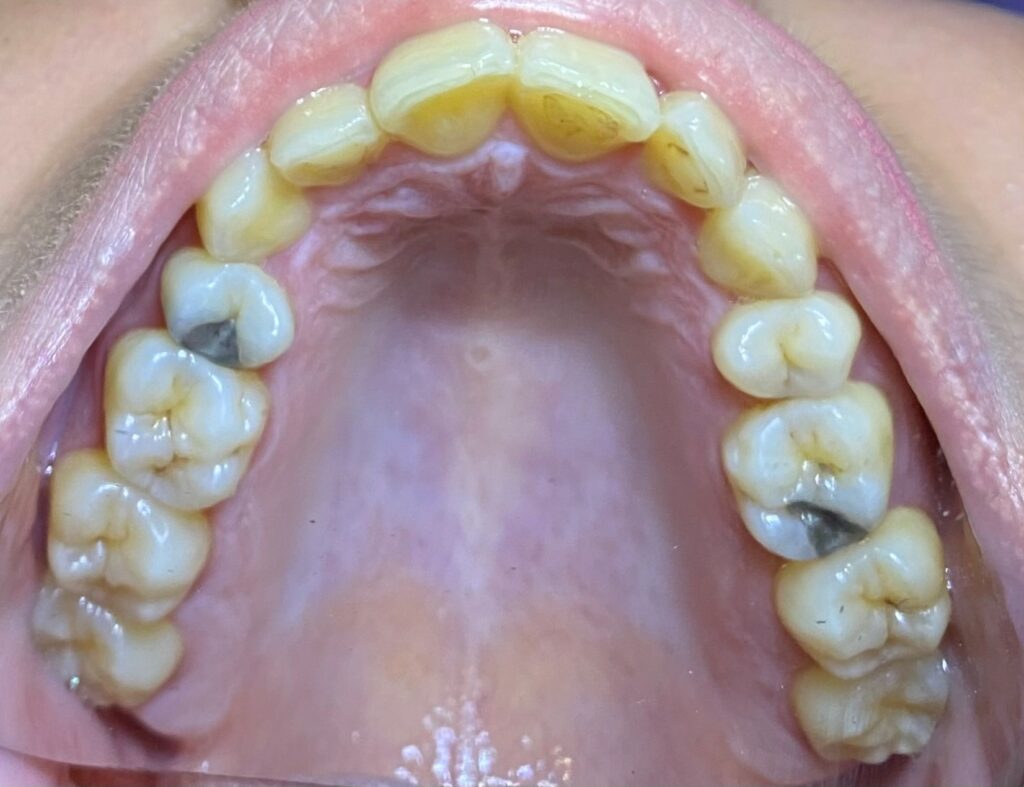 ορθοδοντική ενηλίκων