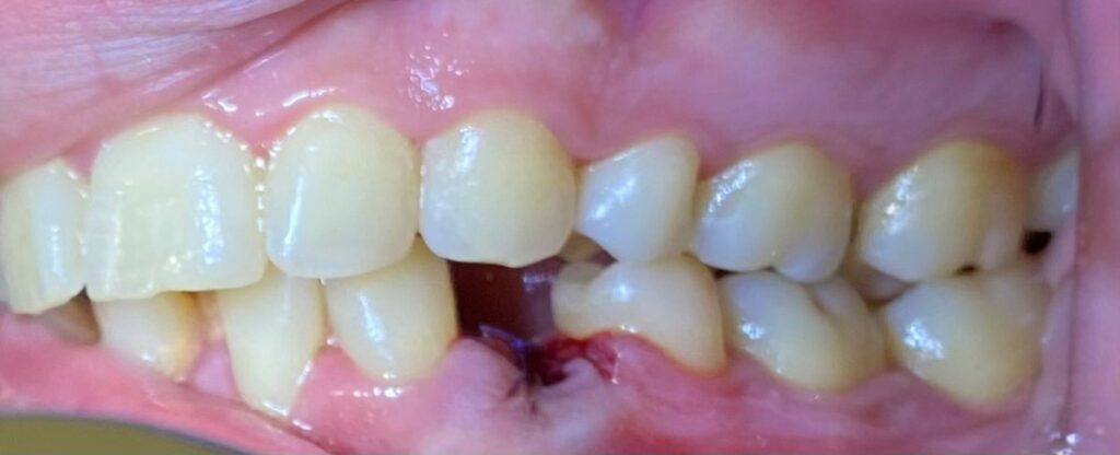 ορθοδοντική ενηλίκων