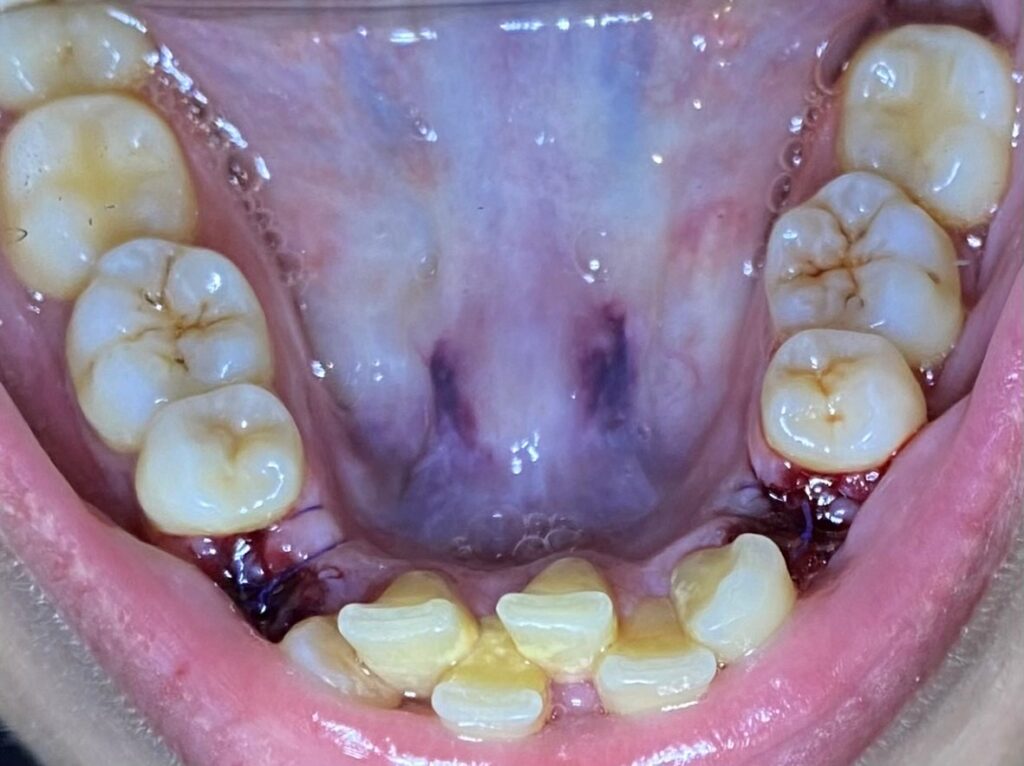 ορθοδοντική ενηλίκων